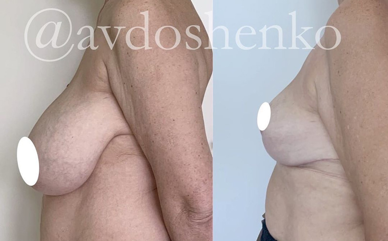 Редукционная маммопластика, фото до и после