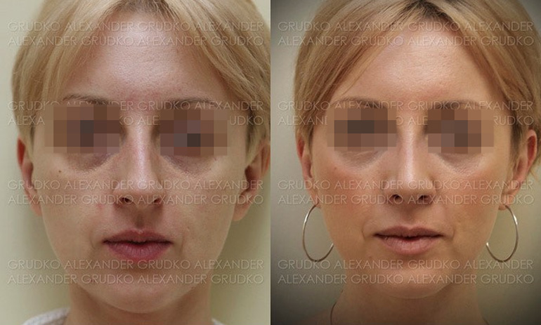 Ринопластика у пластического хирурга Грудько А. В., фото до и после