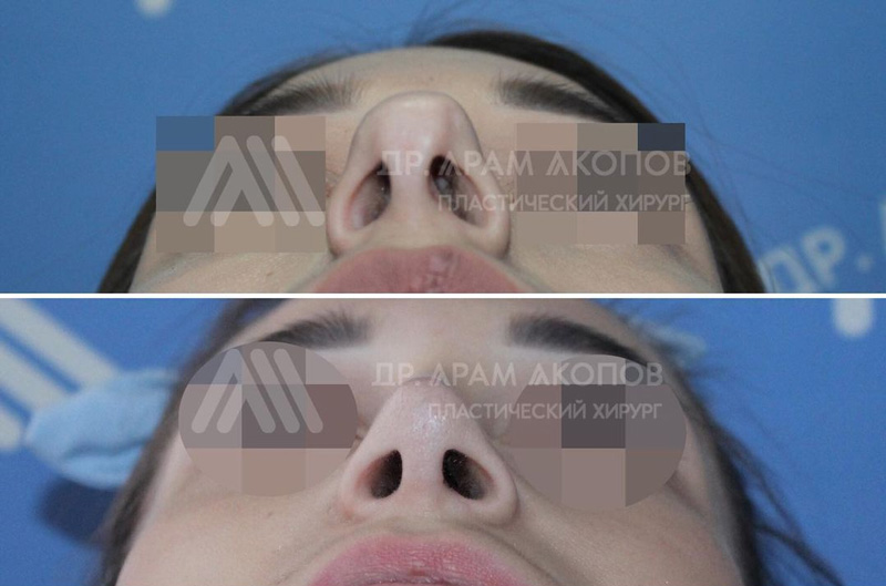 Риносептопластика у пластического хирурга Акопова А. А., фото до и после