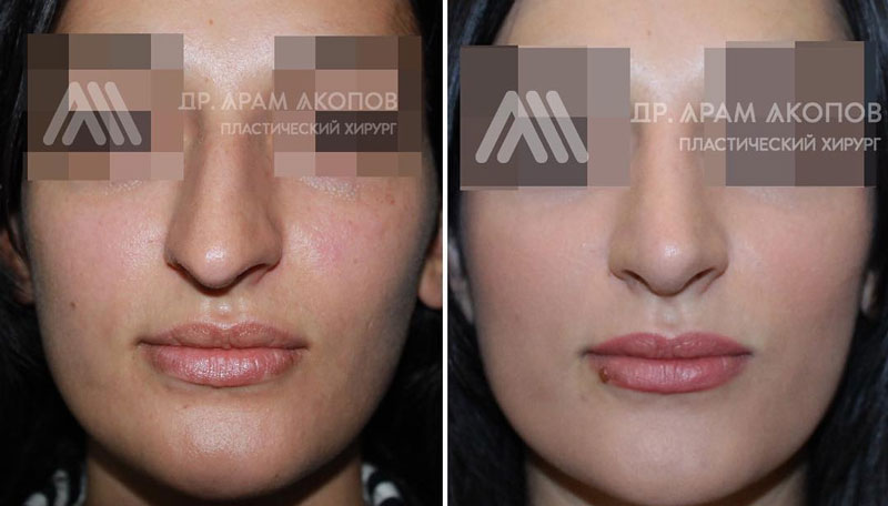 Удаление горбинки, подъем кончика и выравнивание носа, фото до и после