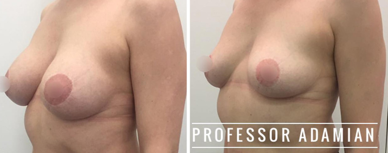 Удаление имплантатов и подтяжка груди, фото до и после