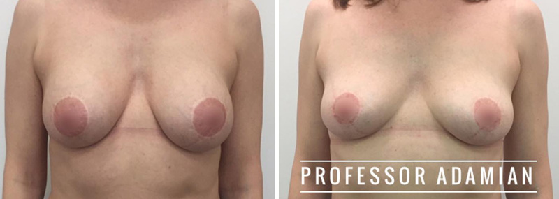 Удаление имплантатов и подтяжка груди, фото до и после