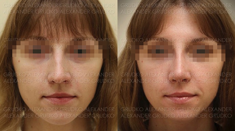 Уменьшение носа и восстановление дыхания, фото до и после
