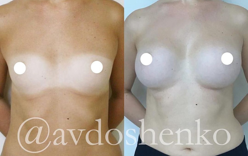 Увеличение груди анатомическими имплантами 520 мл, фото до и после