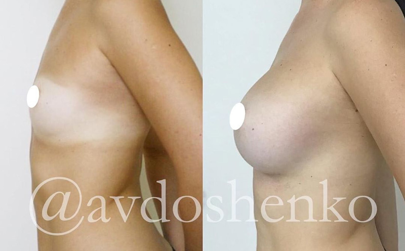 Увеличение груди анатомическими имплантами 520 мл, фото до и после