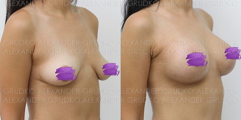 Увеличение груди с подтяжкой вокруг ареолы, фото до и после