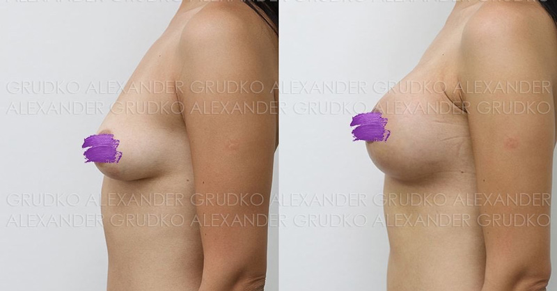 Увеличение груди с подтяжкой вокруг ареолы, фото до и после