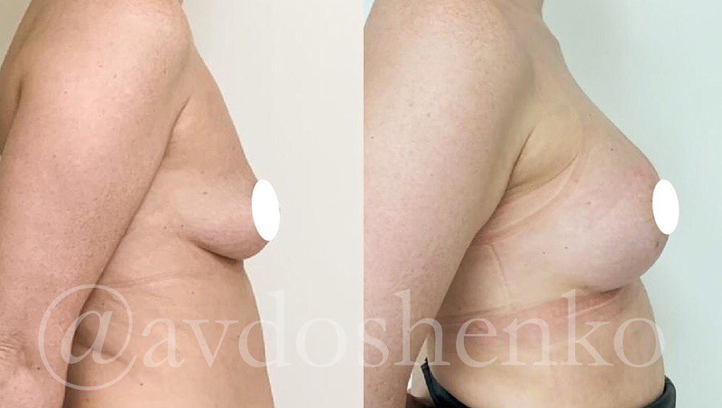 Увеличение груди силиконовыми анатомическими имплантами 375 мл