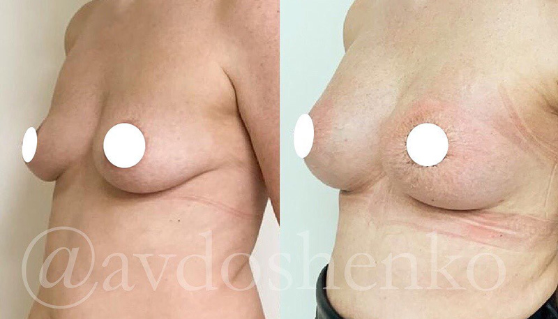 Увеличение груди силиконовыми анатомическими имплантами 375 мл