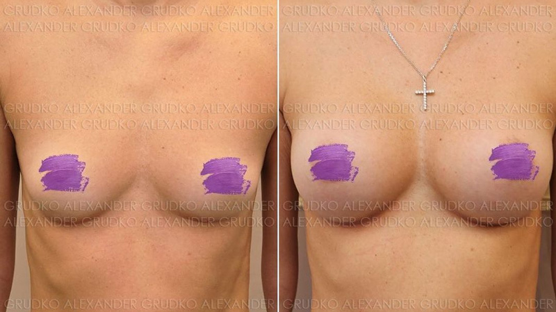 Увеличение груди в 1-го до 3-го размера, фото до и после