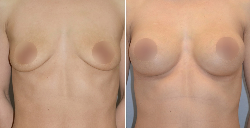 Увеличивающая маммопластика у Агапова Д. Г., фото до и после