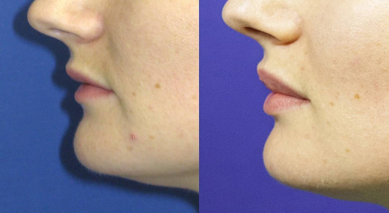 Хирургическое увеличение губ с помощью VY пластики, фото до и после