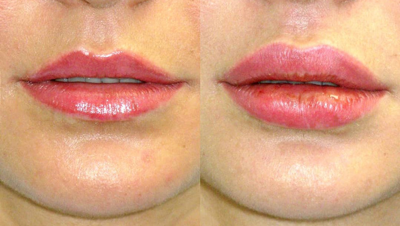 Хирургическое увеличение верхней и нижней губы, фото до и после