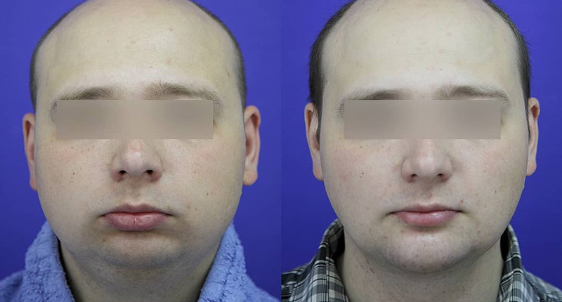 Ментопластика с индивидуальным имплантом у доктора Гурьянова А. С., фото до и после
