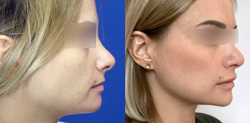 Ментопластика, уменьшение углов нижней челюсти и пластика губ, фото до и после