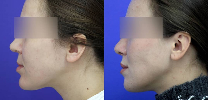 Уменьшающая гениопластика у хирурга Гурьянова А. С., фото до и после