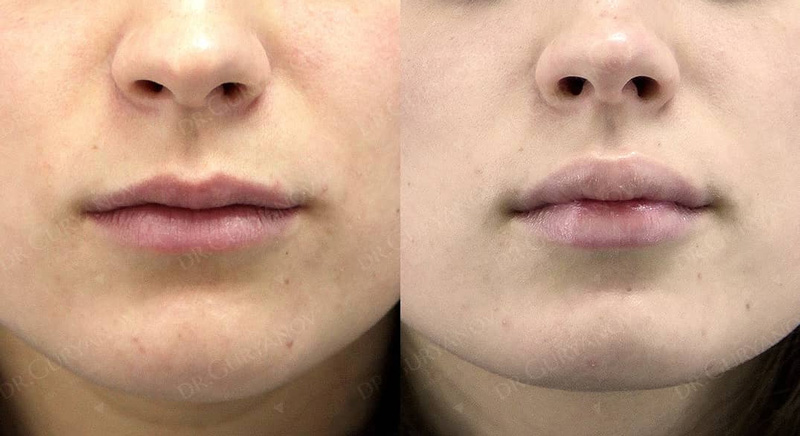VY пластика губ у доктора Гурьянова А. С., фото до и после