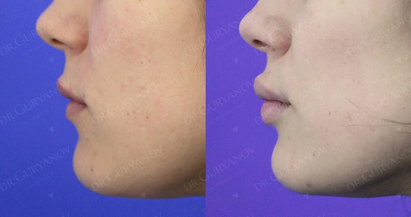 VY пластика губ у доктора Гурьянова А. С., фото до и после