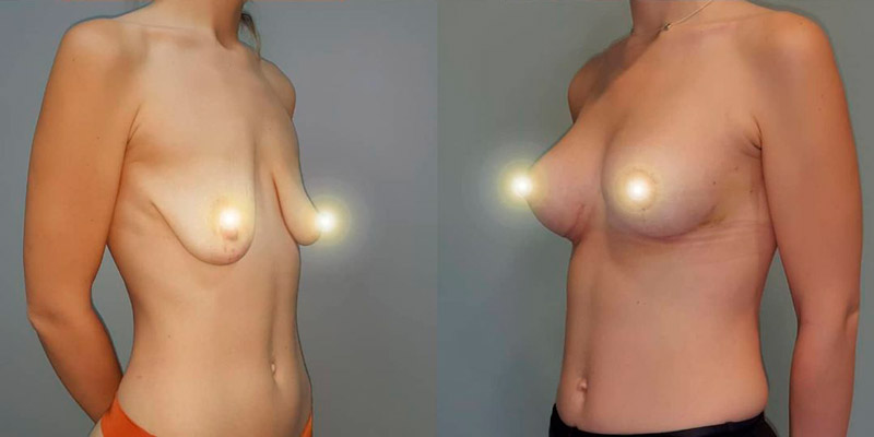 Подтяжка груди с увеличением, фото до и после