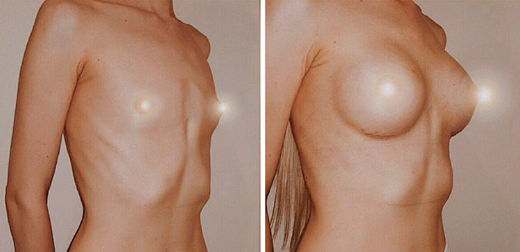 Увеличение груди круглыми имплантатами 275 г. фото до и после