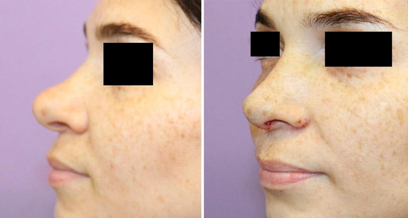 Коррекция бульбообразного кончика носа, фото до и после
