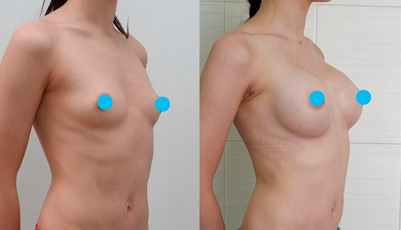 Увеличение груди через трансаксиллярный доступ, фото до и после