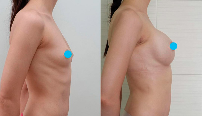 Увеличение груди через трансаксиллярный доступ, фото до и после