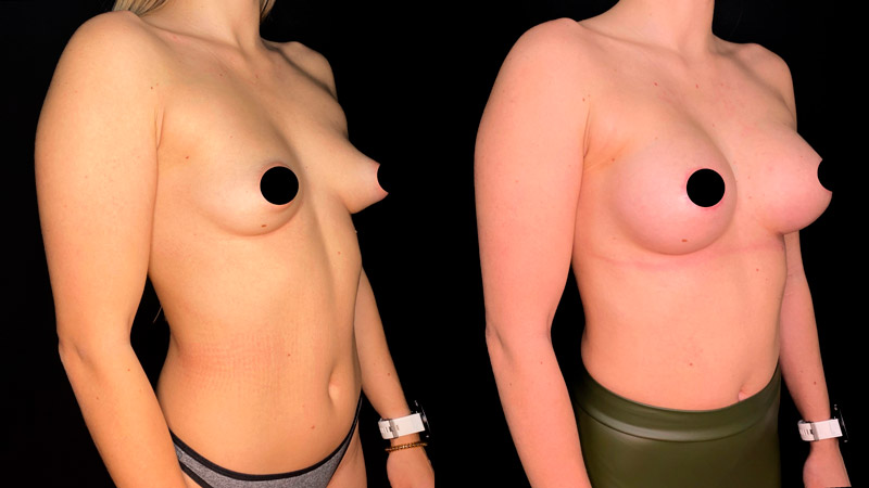Коррекция тубулярной груди, фото до и после
