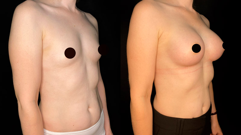 Увеличение груди анатомическими имплантами 300 мл, фото до и после