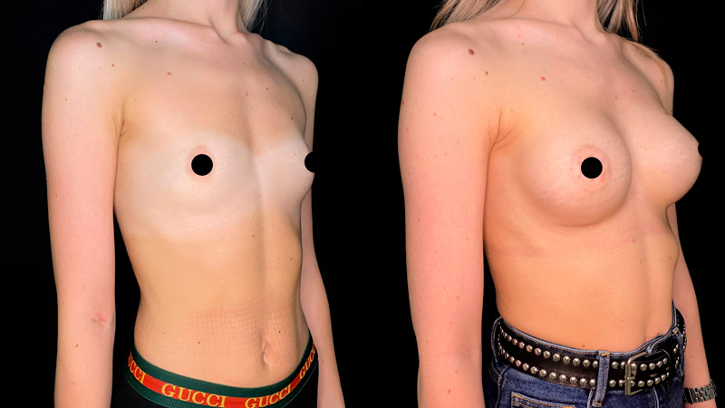 Увеличение груди имплантами МЕНТОР 250мл, фото до и после
