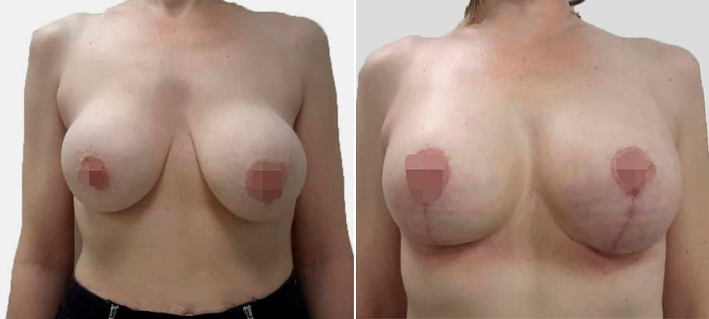 Удаление имплантов с капсулой и увеличивающая мастопексия, фото до и после