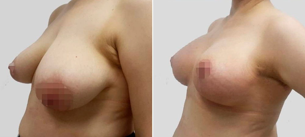 Увеличительная мастопексия с редукцией левой молочной железы, фото до и после