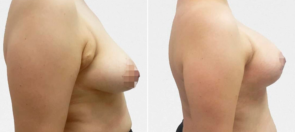 Увеличительная мастопексия с редукцией левой молочной железы, фото до и после