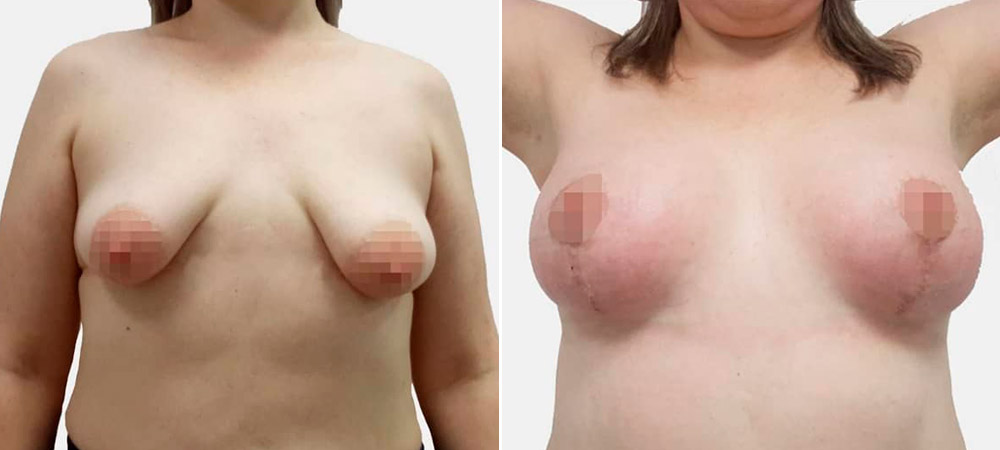 Увеличительная мастопексия у пластического хирурга Кравченко В. И., фото до и после